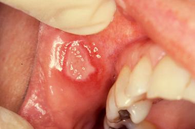 recurrent aphthous ulcers