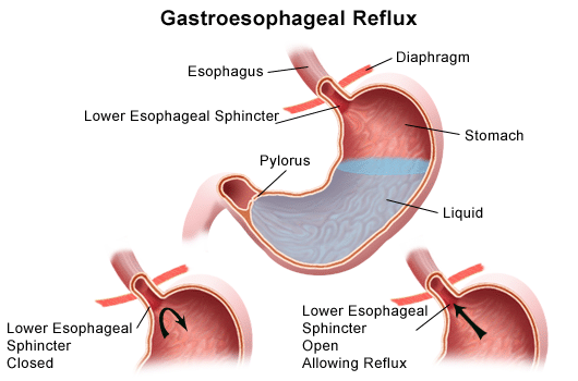reflux esophagitis