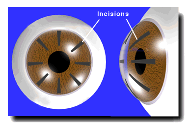 refractive keratotomy