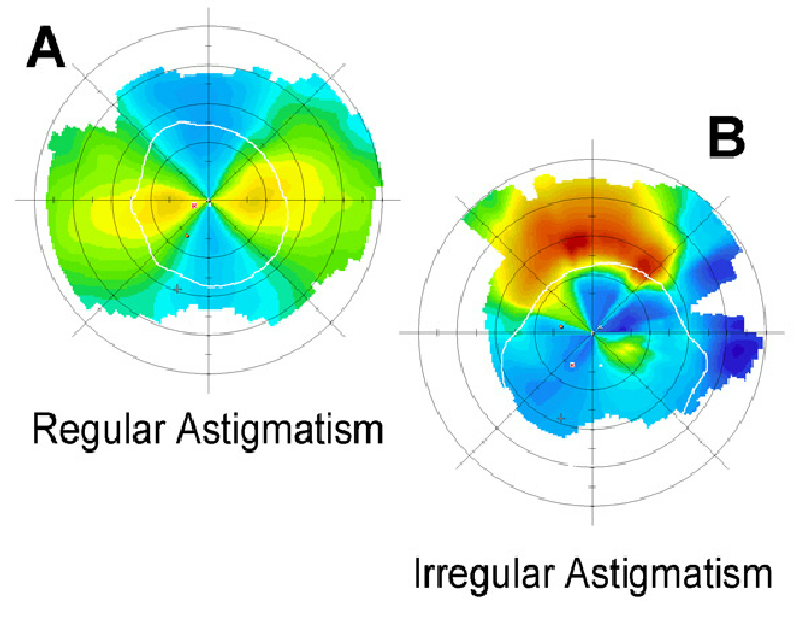 regular astigmatism