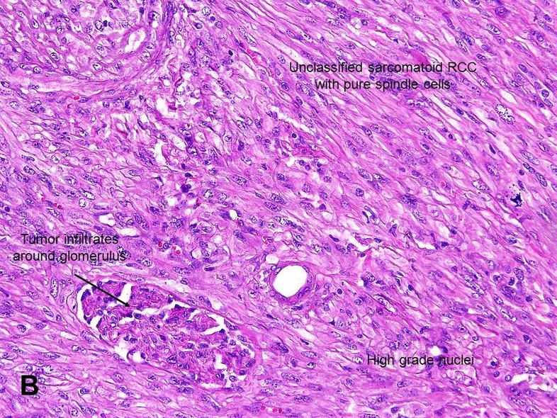 renal carcinosarcoma