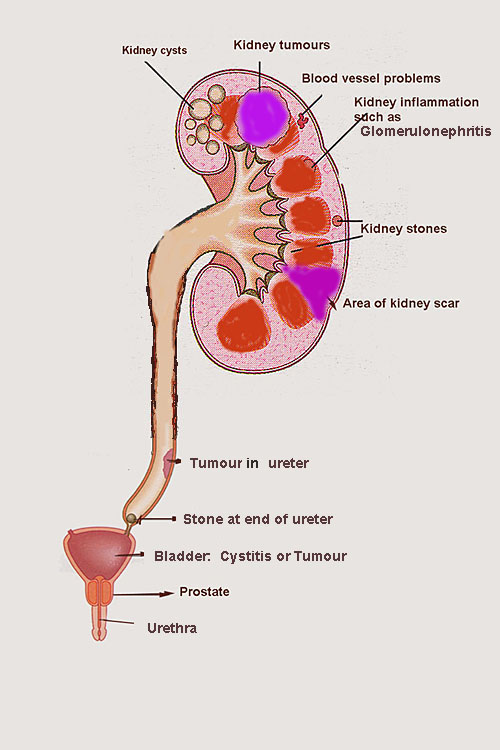 renal hematuria