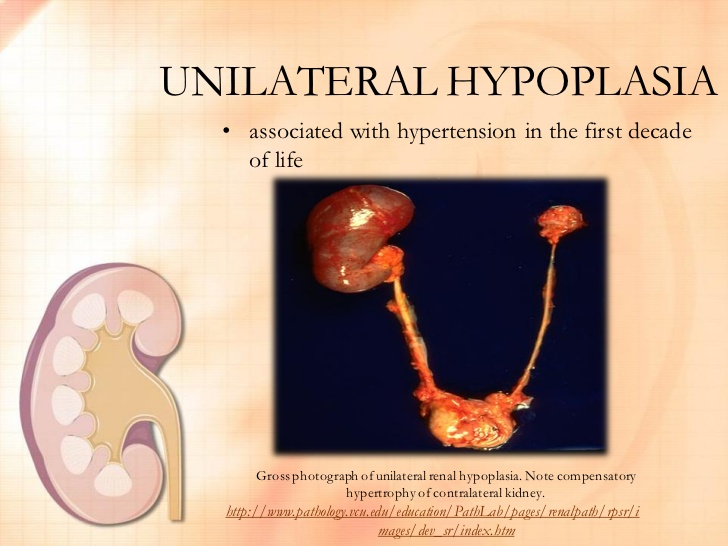 renal hypoplasia