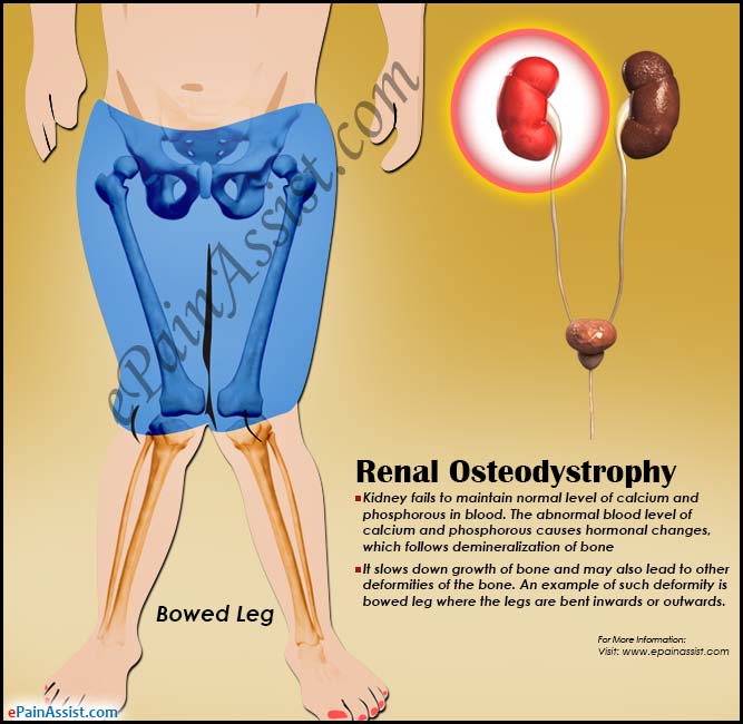 renal osteodystrophy
