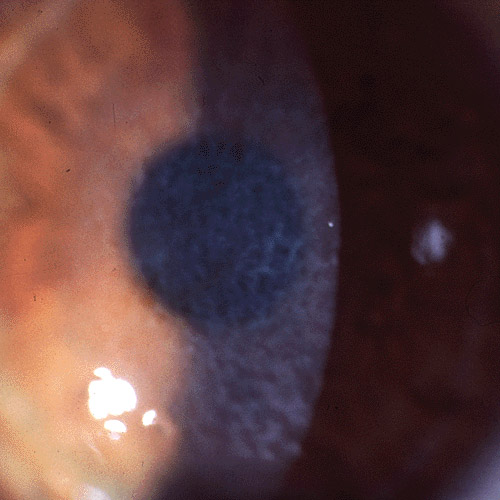 reticular dystrophy of cornea