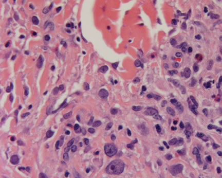 reticulum cell sarcoma