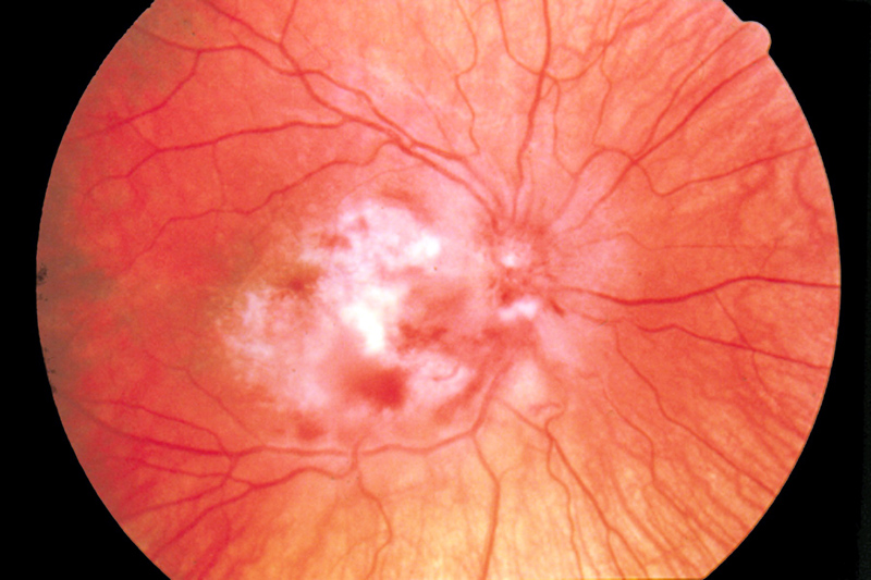 retinitis proliferans