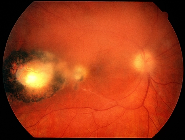 retinochoroiditis