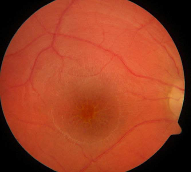 retinoschisis