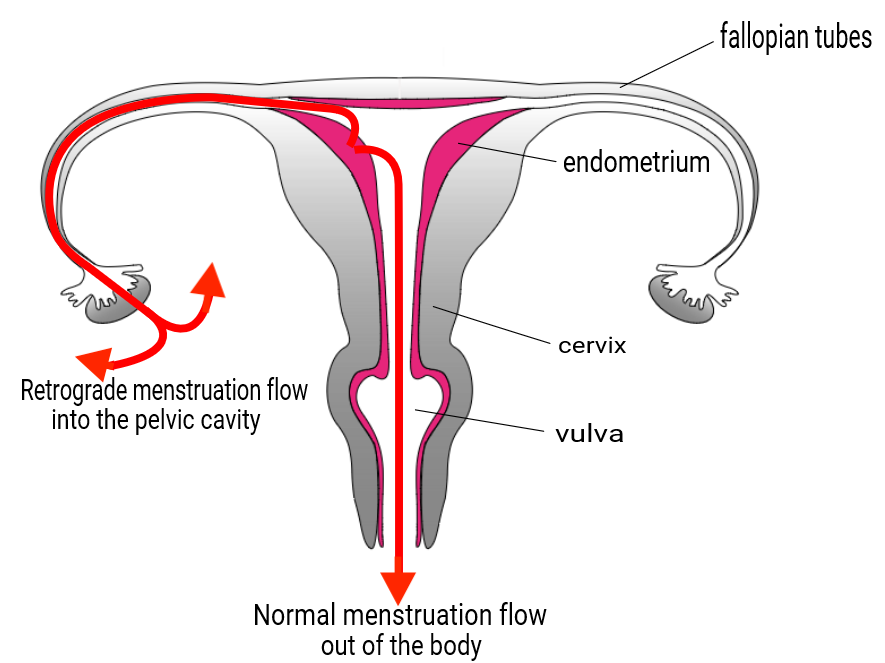 retrograde menstruation