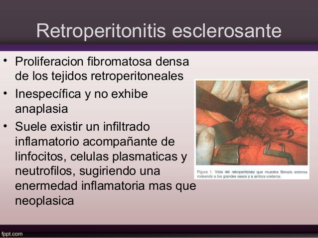 retroperitonitis