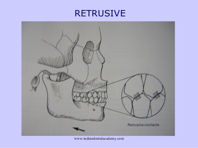 retrusive occlusion
