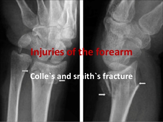 reverse colles' fracture