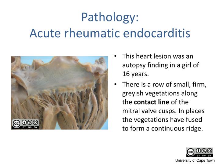 rheumatic endocarditis