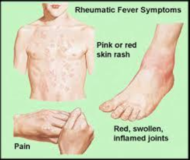 rheumatic fever