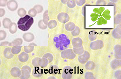 rieder cell leukemia