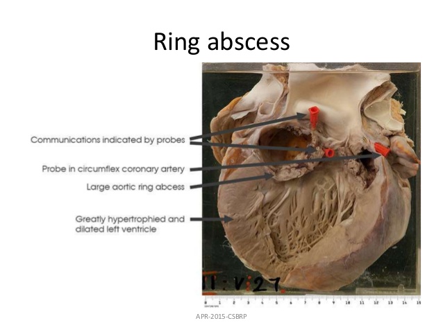 ring abscess