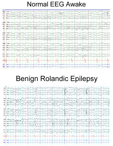 rolandic epilepsy