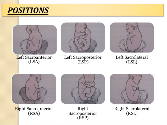 sacroposterior position