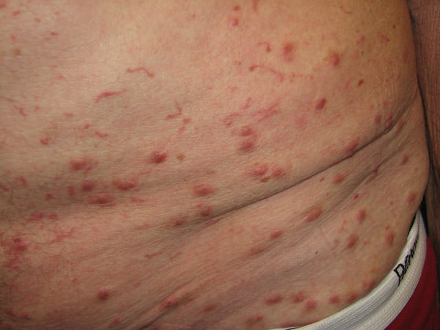 scabies