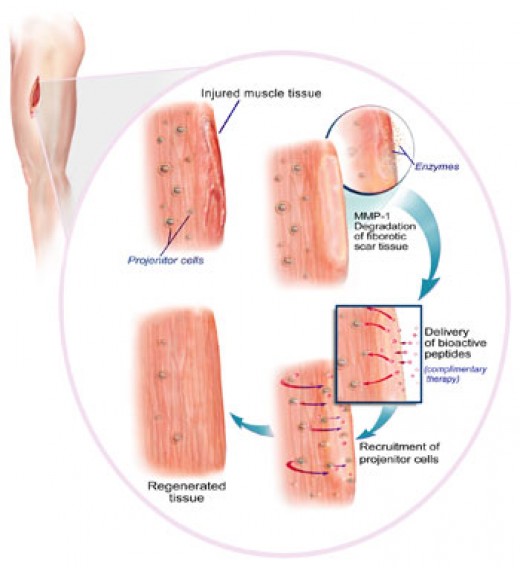 scar tissue