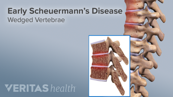 scheuermann's disease