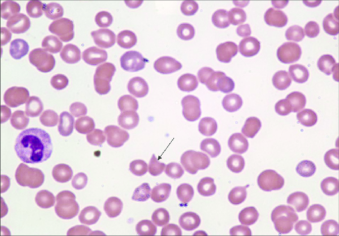 schistocyte