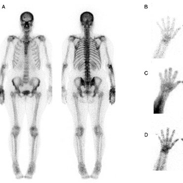 scintigraphy