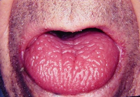 scrotal tongue