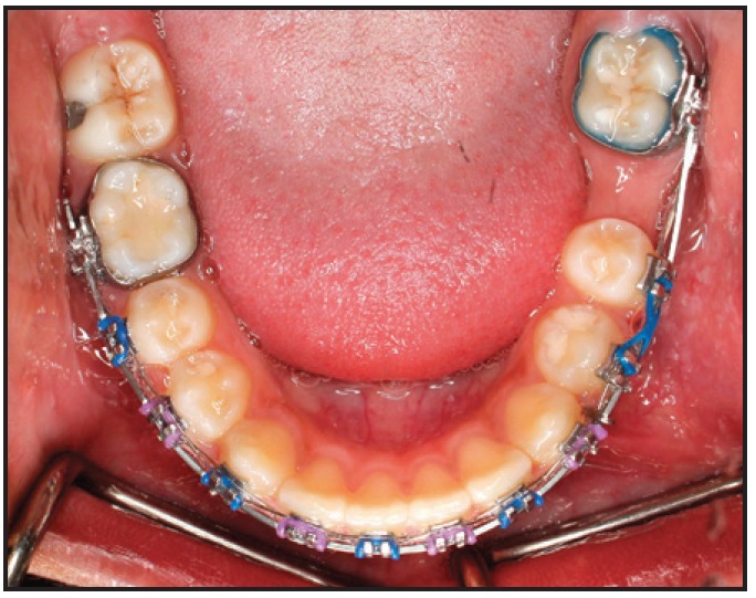 second molar