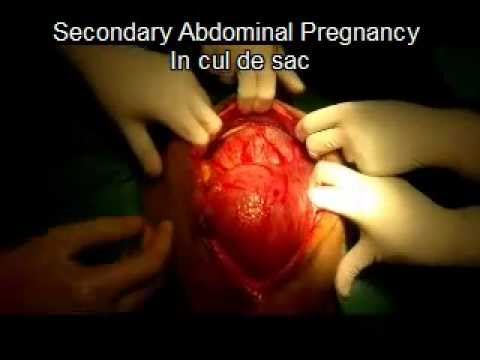 secondary abdominal pregnancy