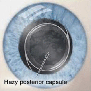 secondary cataract