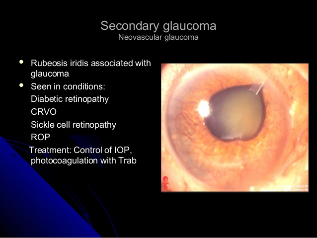 secondary glaucoma