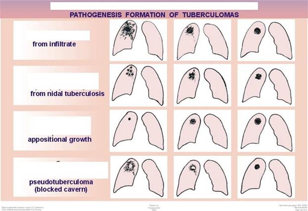 secondary tuberculosis