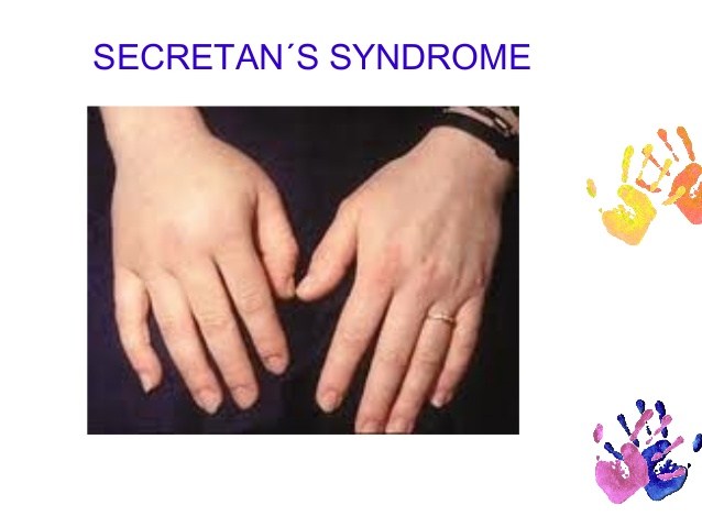 secrétan's syndrome