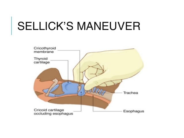 sellick's maneuver