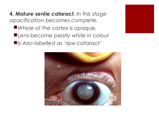 senile cataract