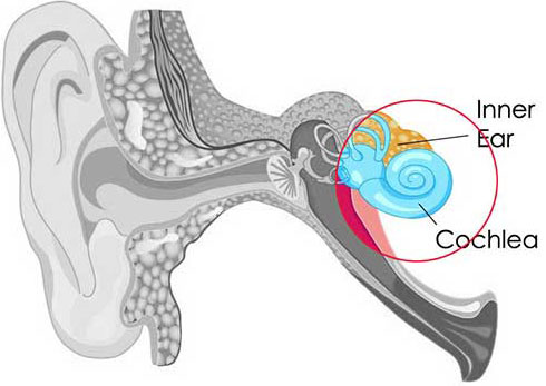 sensorineural hearing impairment