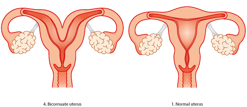 septate uterus