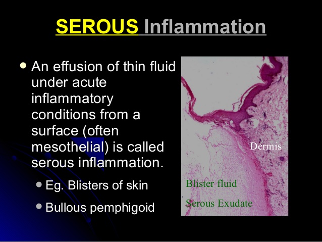 serous inflammation