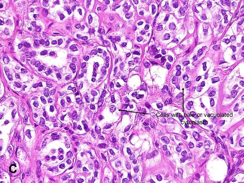 sertoli cell tumor