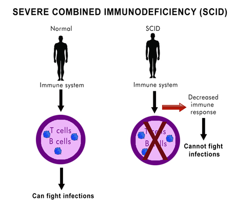 severe combined immunodeficiency