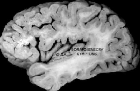 short gyrus of insula