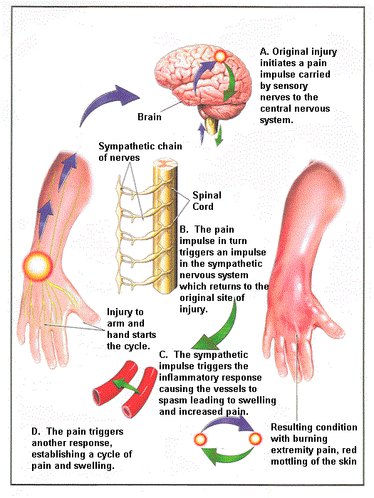 shoulder-hand syndrome
