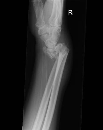Smith’s fracture