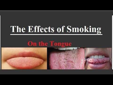 smoker’s tongue