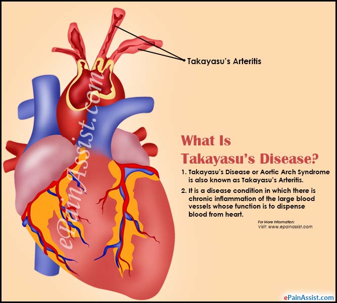 takayasu's disease