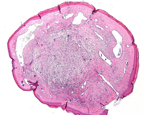 telangiectatic fibroma