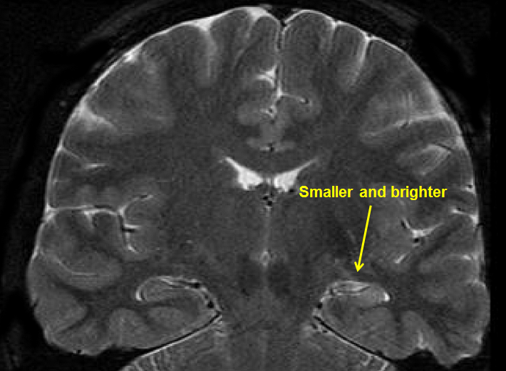 temporal-lobe epilepsy