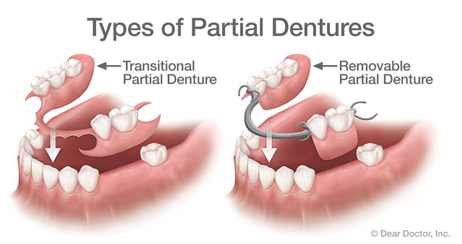 temporary denture